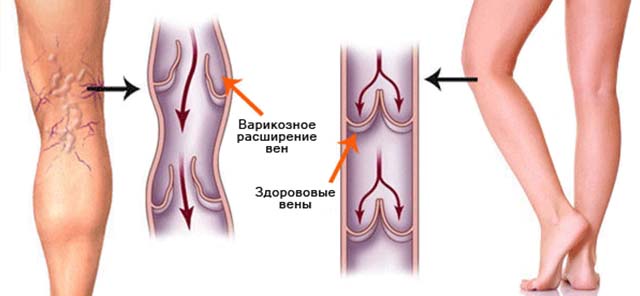 Варикоз вен