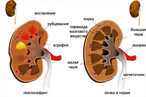 Пиелонефрит