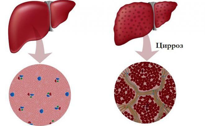 Цирроз