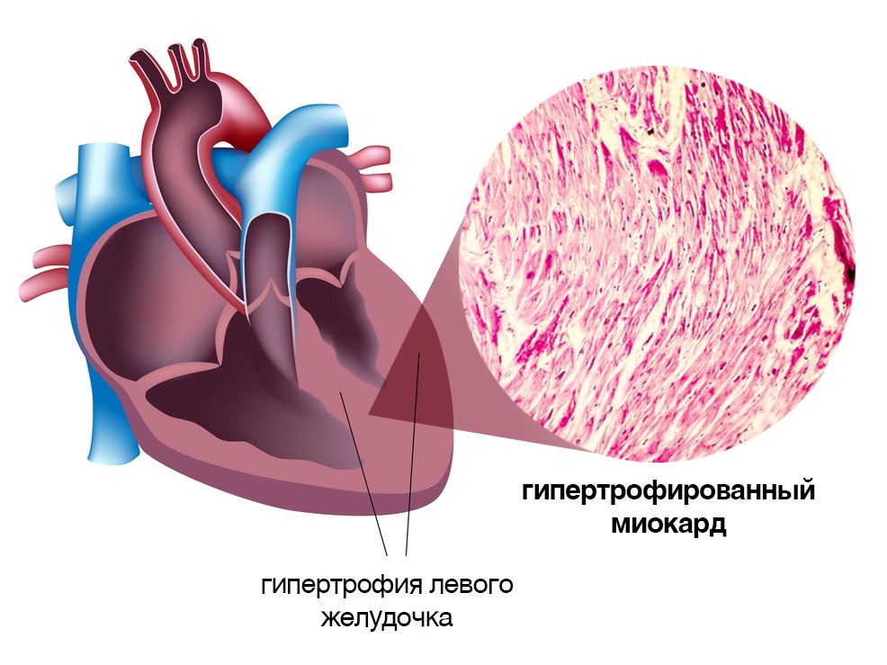 Глж сердца. Гипертрофия миокарда желудочков. Компенсаторная гипертрофия левого желудочка. Гипертрофия миокарда левого желудочка. Осложнения миокардита.