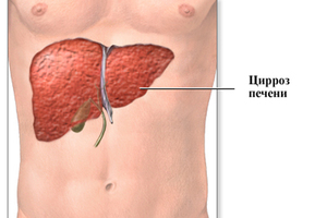 Цирроз печени - причины заболевания.