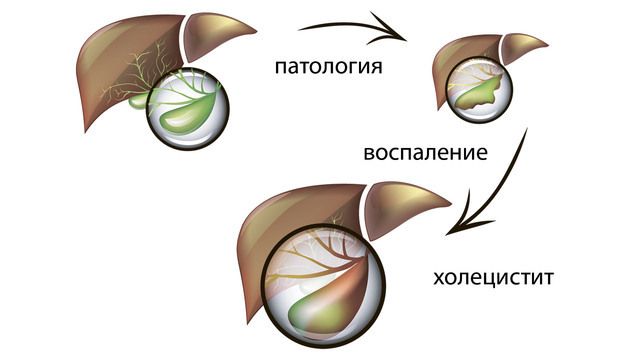 Развитие воспаления желчного пузыря