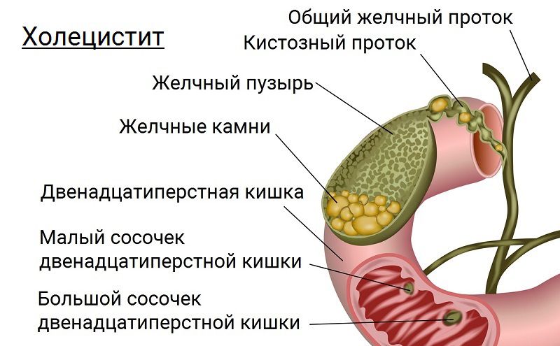 Желчный пузырь холецистит