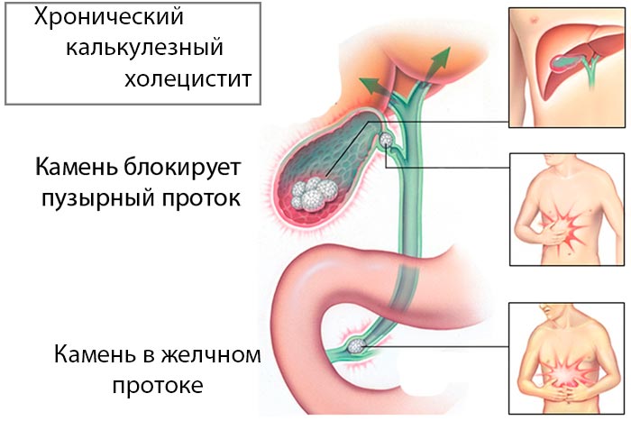 Хронический калькулезный холецистит