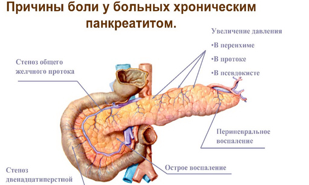 Хронический панкреатит - причины боли