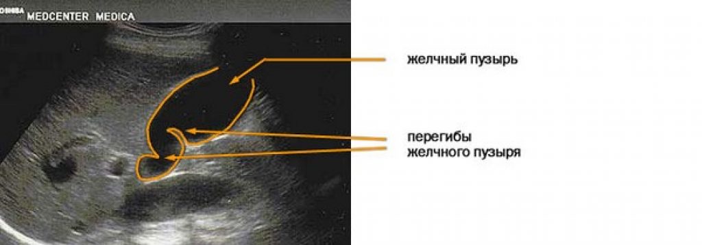 Перегиб желчного пузыря УЗИ