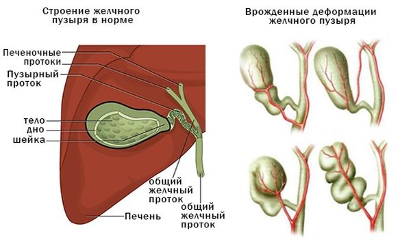 Виды деформаций желчного пузыря