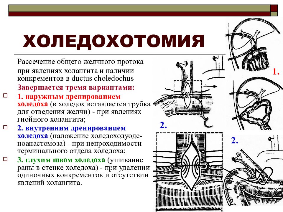 Холедохотомия - анатомия и определение