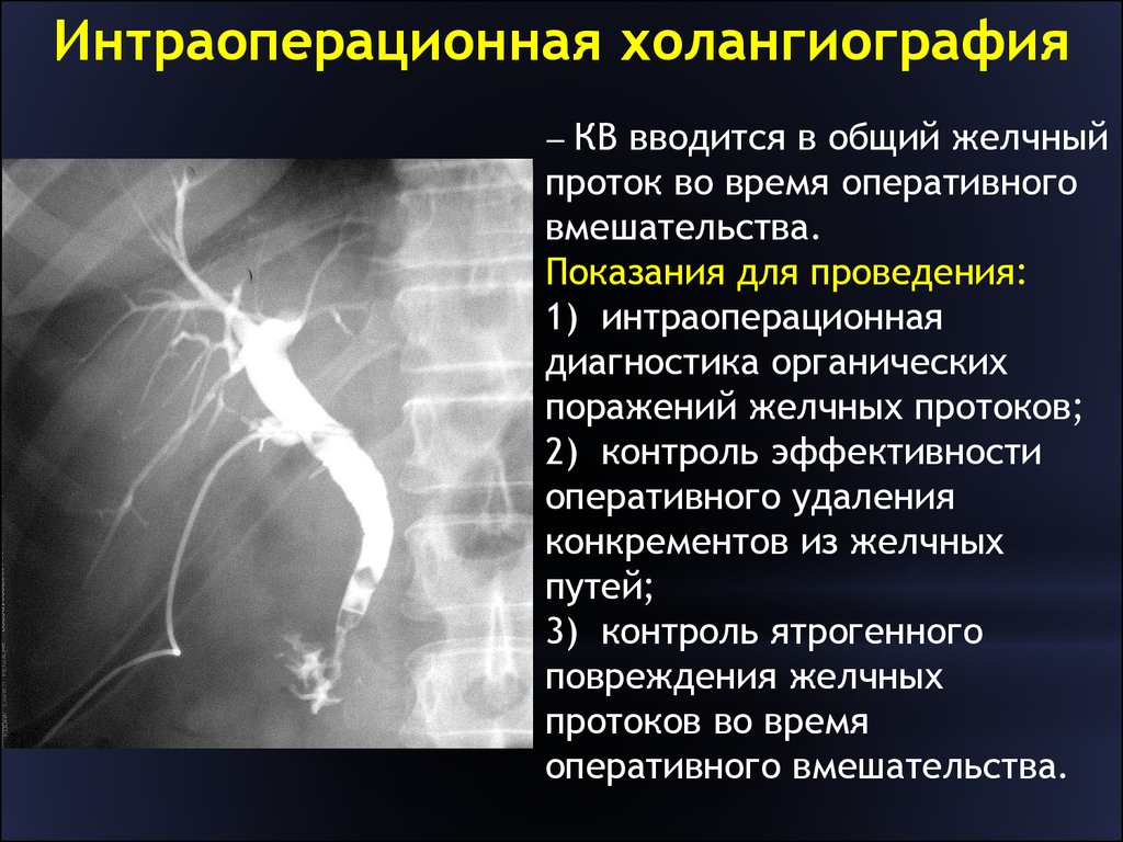 Интраоперационная холангиография - определение и УЗИ