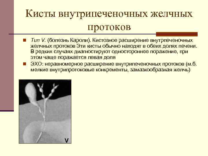 Анатомия и определение расширения желчного протока 