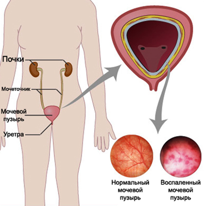 Женский цистит