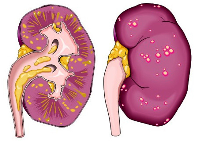 Как выглядит гнойный пиелонефрит