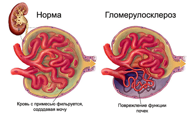 Гломерулосклероз