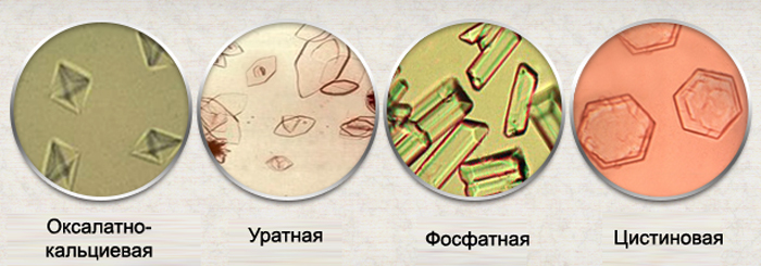 Виды кристаллурии