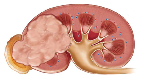 Опухоль почки