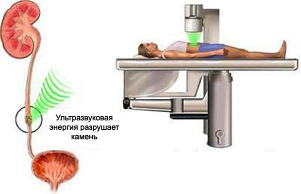 Литотрипсия