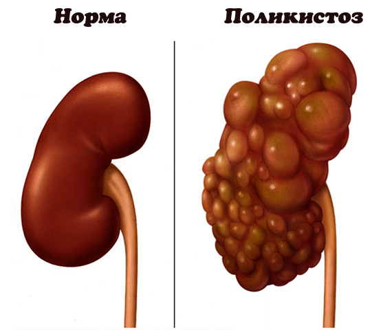 Поликистоз