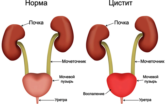 Цистит