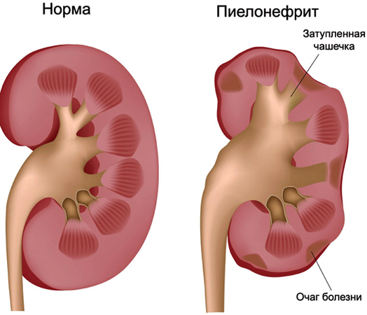 Пиелонефрит