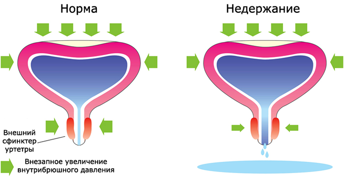 Недержание у женщин