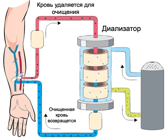 Гемодиализ