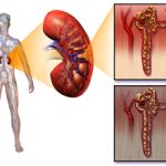 Нефропатия почек — что это такое, причины, симптомы и лечение