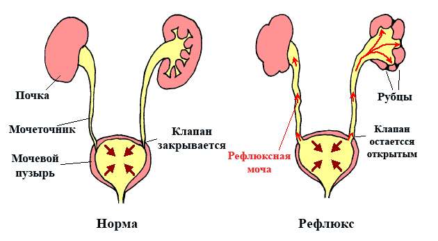 Норма и рефлюкс