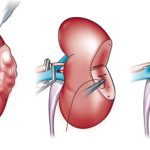 Резекция почки: что это, проведение и послеоперационный период