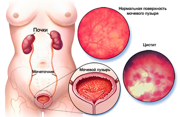 У женщины цистит