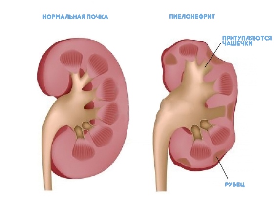 пиелонефрит