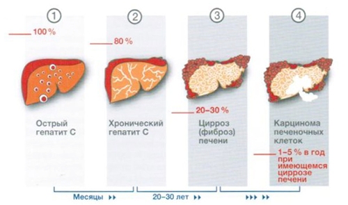 Развитие болезни