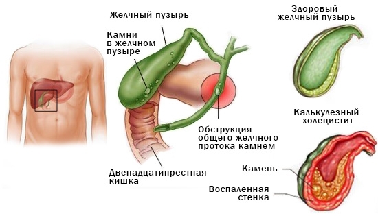 Как проявляется болезнь