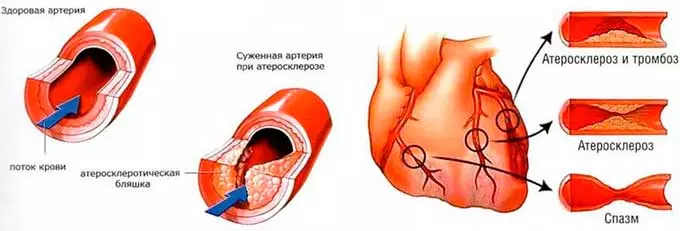 поражение сосудов