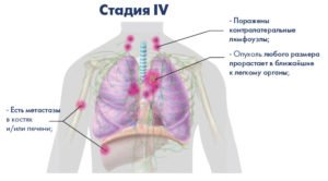 Последняя стадия рака легких