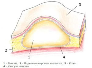 жировик на спине