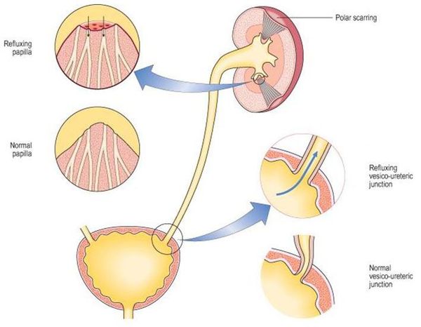 Пузырно-мочеточниковый рефлюкс