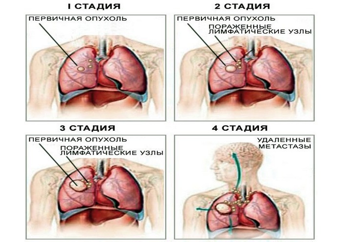 Стадии рака