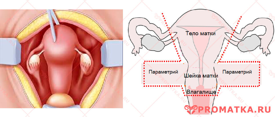 Расширенная радикальная гистерэктомия