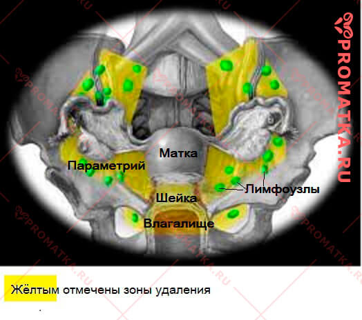 Радикальная трахелэктомия – схема