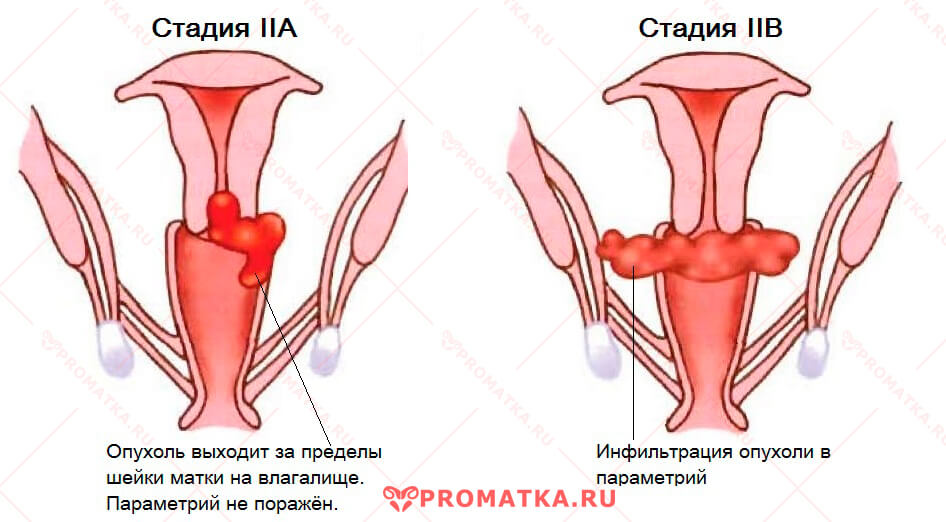 Стадии матки. Онкология 2 степени шейки матки. Новообразования во влагалище матки.