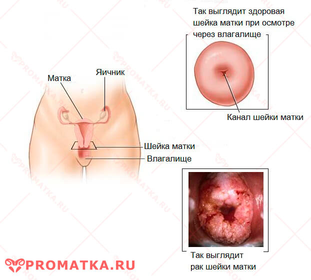 Рак шейки матки – схема