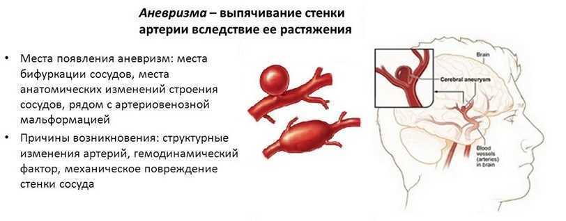 Аневризма выпячивание стенки артерии