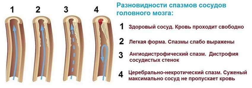 Разновидности спазмов сосудов