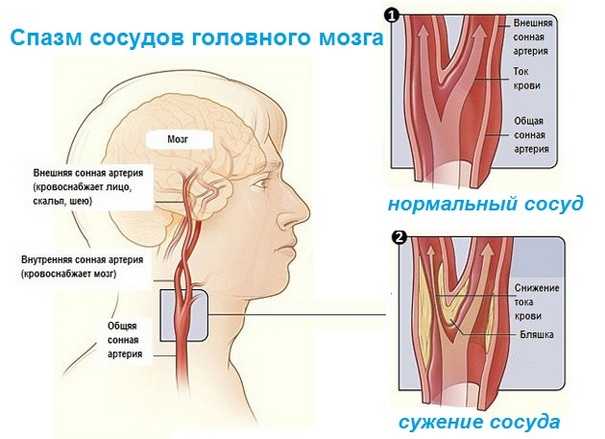 Проявление спазма сосудов головного мозга
