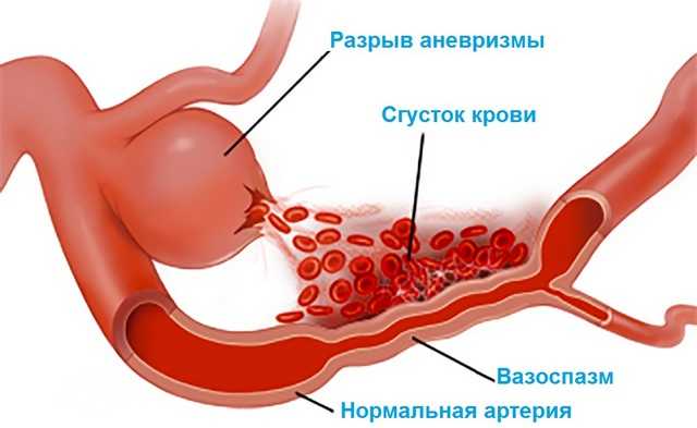 Вазоспазм сосудов