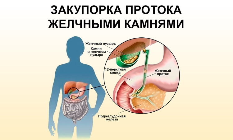 Обтурации желчного протока камнями