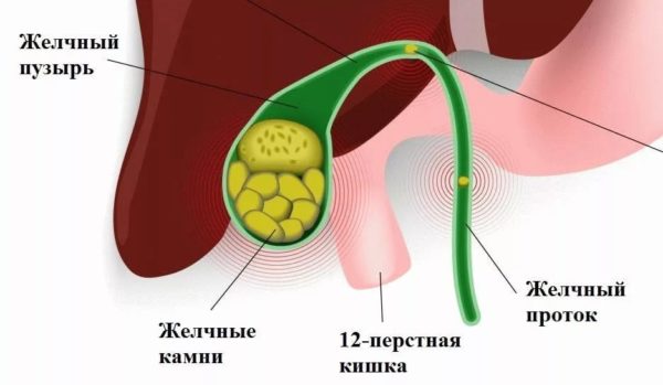 Какие фрукты можно есть при камнях в желчном пузыре?