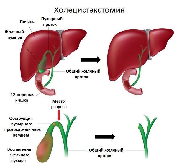 Можно ли принимать Аллохол после удаления желчного пузыря?