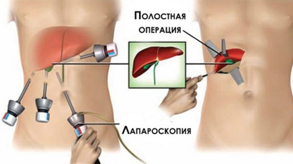 Восстановление после удаления желчного пузыря