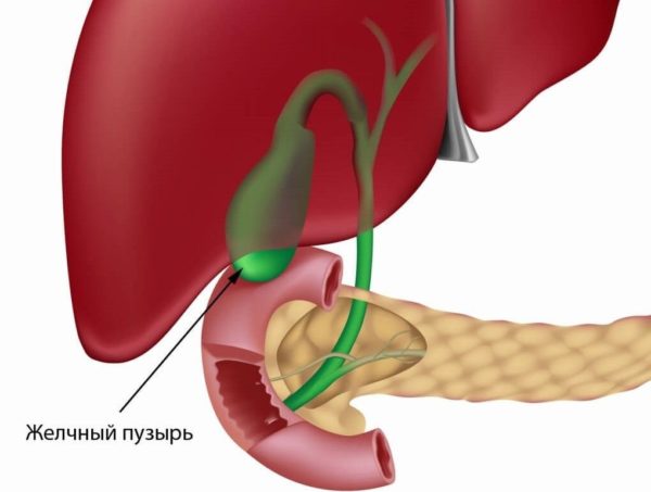Воспаление желчного пузыря